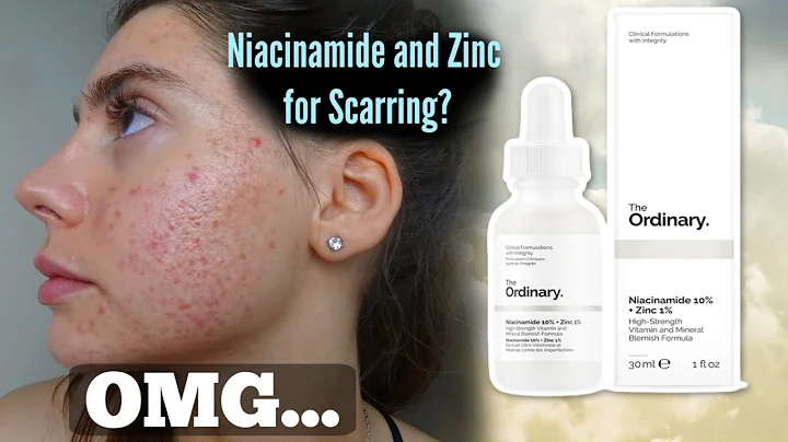 I TESTED THE ORDINARY NIACINAMIDE AND ZINC SERUM FOR MY ACNE SCARS ONE MONTH|| Shocked by this..