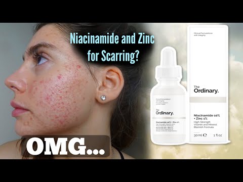 I TESTED THE ORDINARY NIACINAMIDE AND ZINC SERUM FOR MY ACNE SCARS ONE MONTH|| Shocked by this..