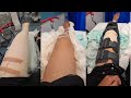 MY FRACTURE KNEE JOURNEY | JOY GERMAN