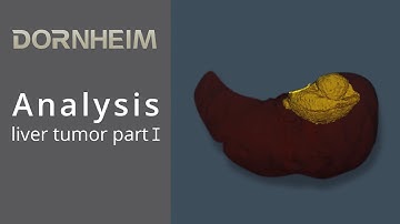 Analysis - liver tumor part I