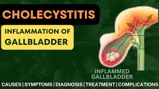 Cholecystitis | Inflammation of Gallbladder | Pathology | Symptoms | Diagnosis | Treatment