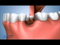 Socket Preservation after tooth extraction.