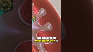 Ureteroscopy is a minimally invasive procedure to treat kidney stones and stones in the ureter.