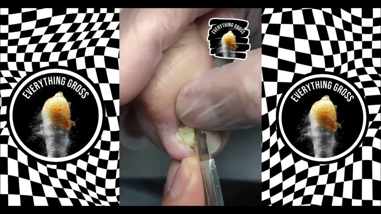 INGROWN TOENAIL REMOVAL YouTube