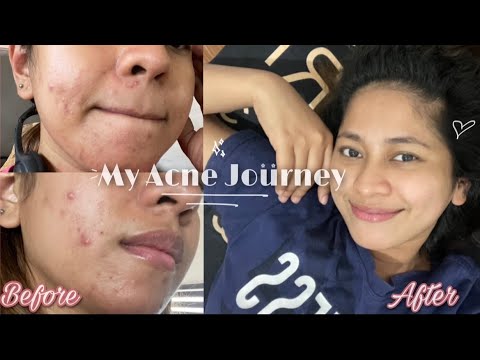 HOW I CLEARED MY SKIN / ACNE JOURNEY (Part 1)| Laiza Lacson - YouTube