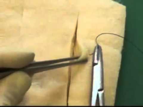 Allgower suture pattern
