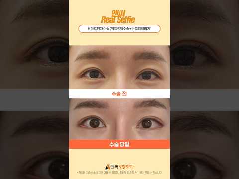 눈트임수술 뒷트임재수술 눈꼬리내리기 당일/1주/3주 후기
