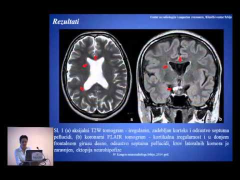 MRI prezentacija kod Septo optičke displazije plus kod odraslog pacijenta sa epilepsijom   Dragana R