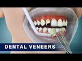 Veneers  step by step preparation and placement of dental veneers  3d animation
