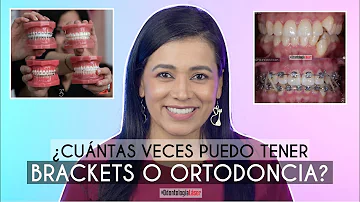 ¿Se puede llevar ortodoncia dos veces?