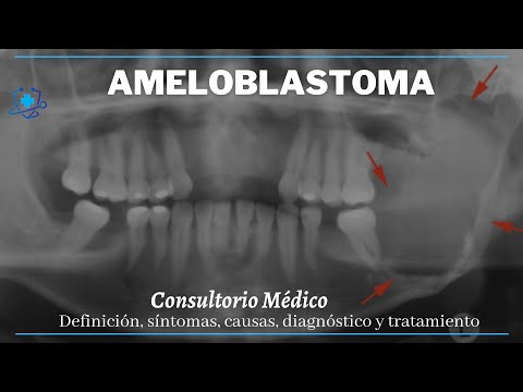 Vídeo: Ameloblastoma - Sintomas, Tratamento, Formas, Etapas, Diagnóstico