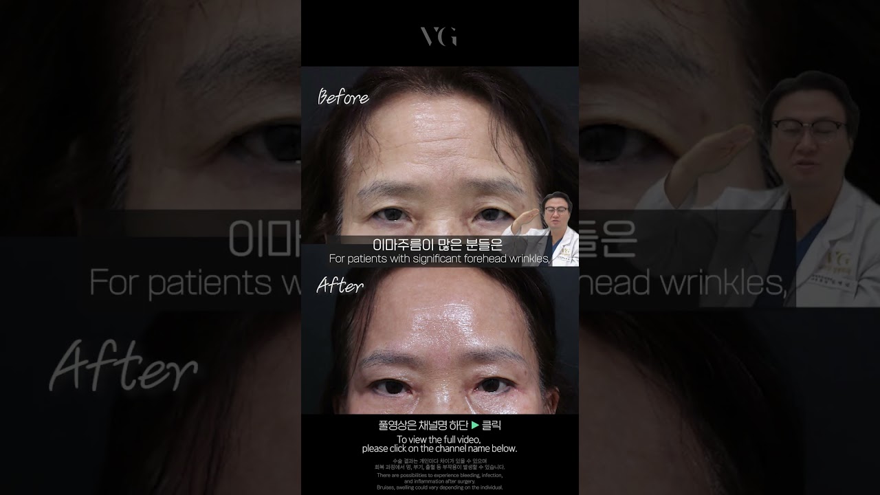 [Вэригүд Гоо сайхны мэс заслын эмнэлэг] Нас хүйс харгалзахгүй хүн бүрийн дунд алдартай дух өргөх мэс заслын үр дүн!