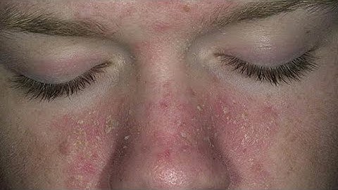 EKZEMA NE FYTYRE | Skuqje ne fytyre | SHKAKU dhe Trajtimi i dermatitit seborreik | #skuqje #lekura