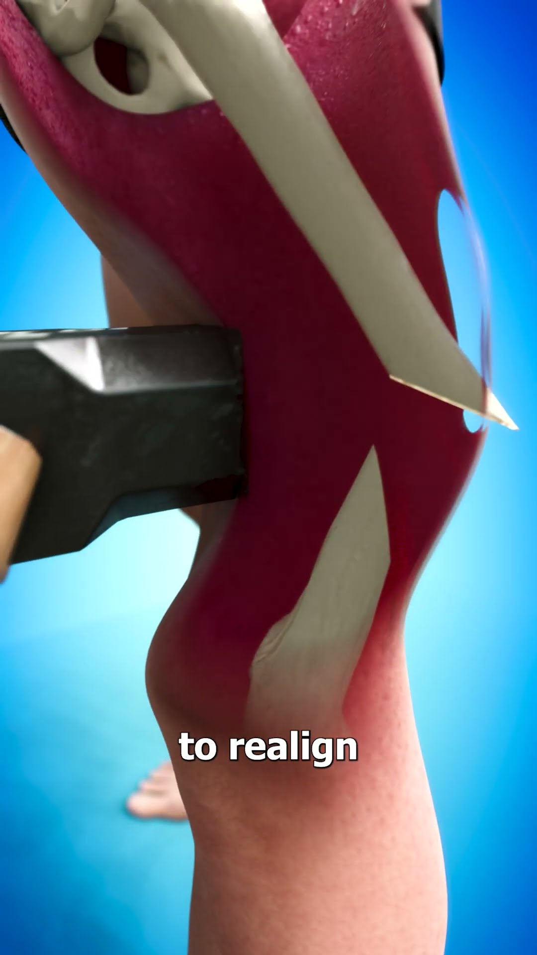 How Broken Bones Are Fixed ?