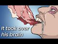 A Man Ate Undercooked Pork, This Is What Doctors Found Inside His Brain