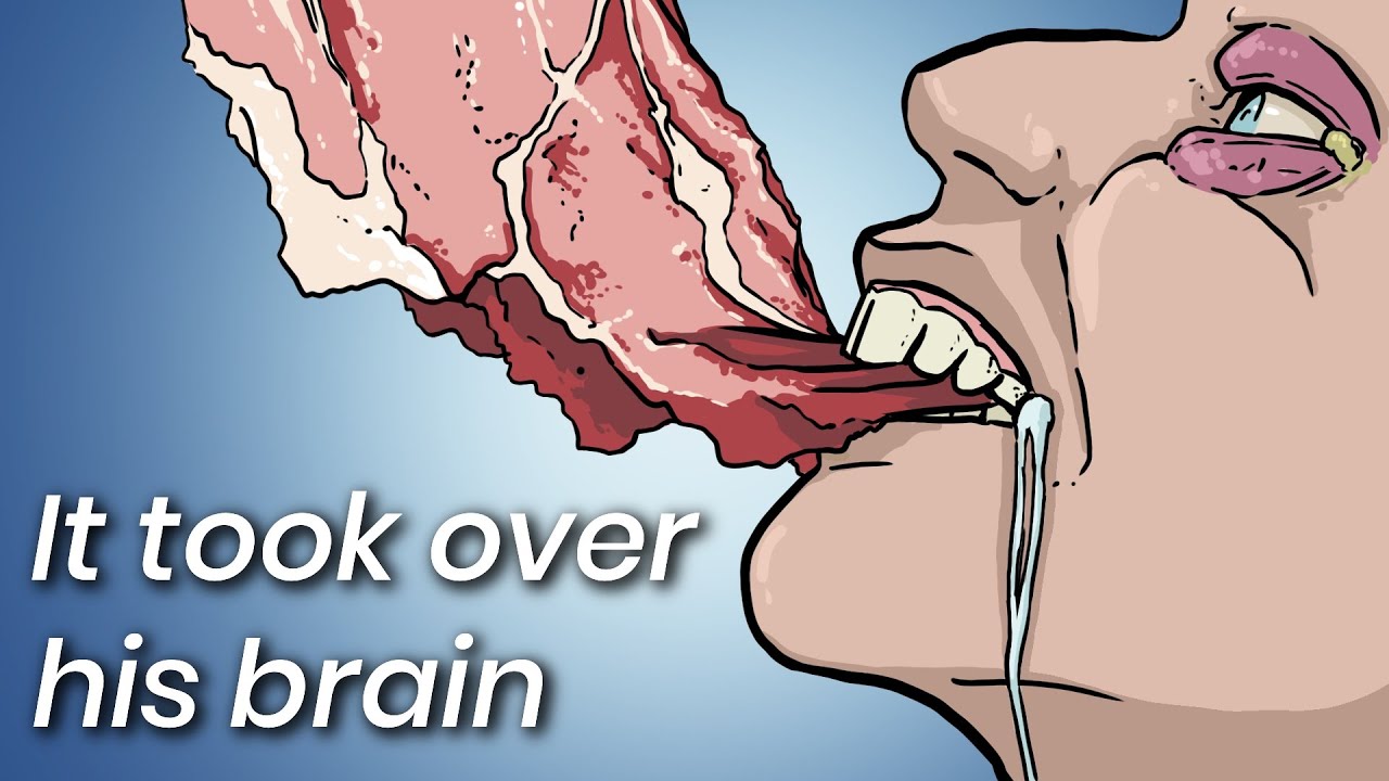 A Man Ate Undercooked Pork, This Is What Doctors Found Inside His Brain