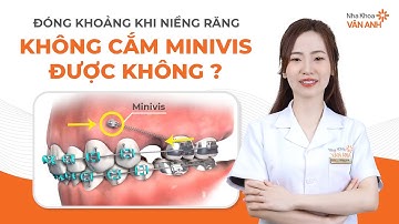 Đóng khoảng khi niềng răng: Không cắm minivis được không?