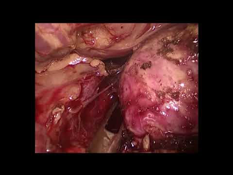 Vídeo: Tumor Pancreático Em Furões