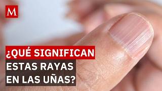 Lines and ridges on your nails: What do they mean and what diseases do they reveal?