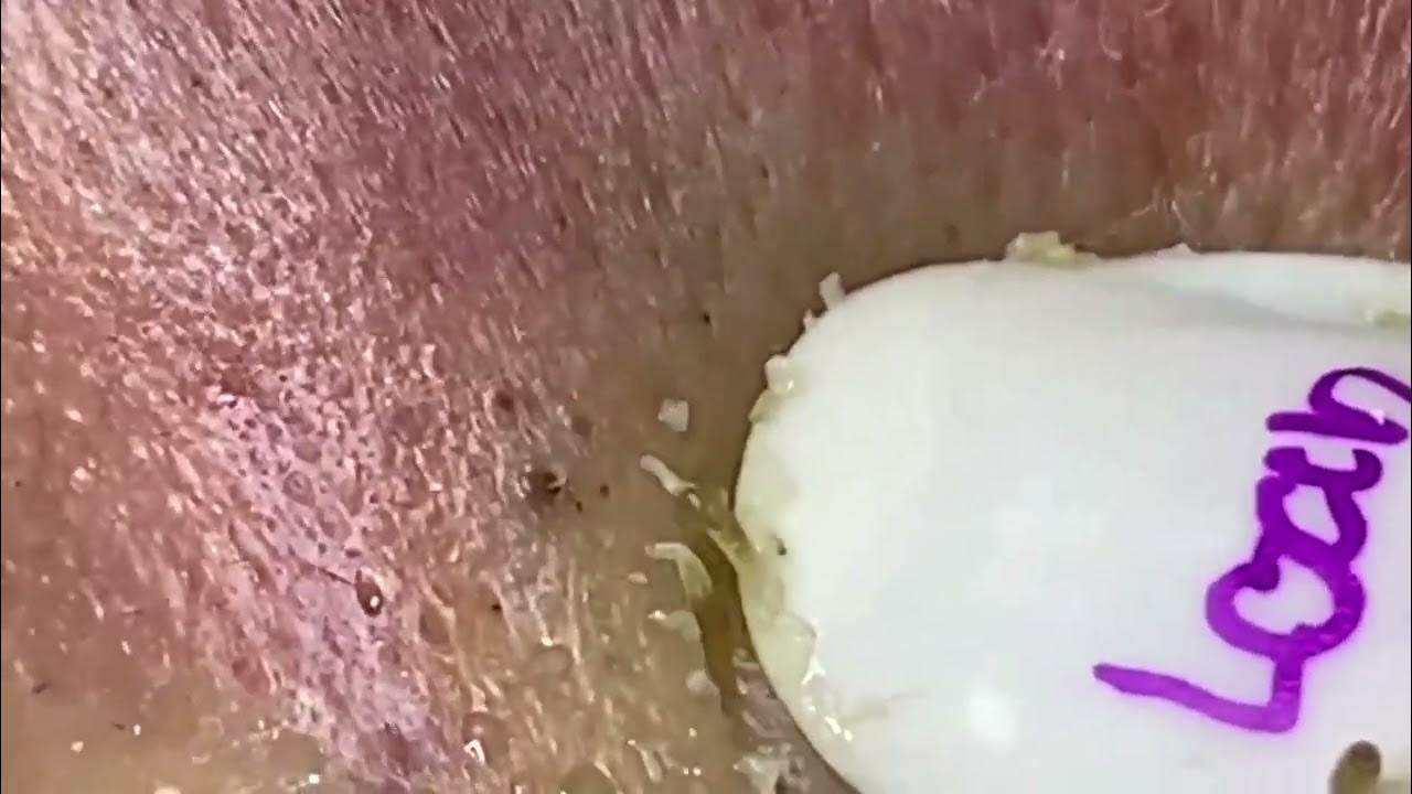 Extreme Blackhead Removal at LNG Skin Care enilsa brown 74276 YouTube