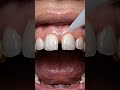 No Braces?! Watch This Gap Disappear 😳🦷.  #NoBraces #TeethGap #GapClosure