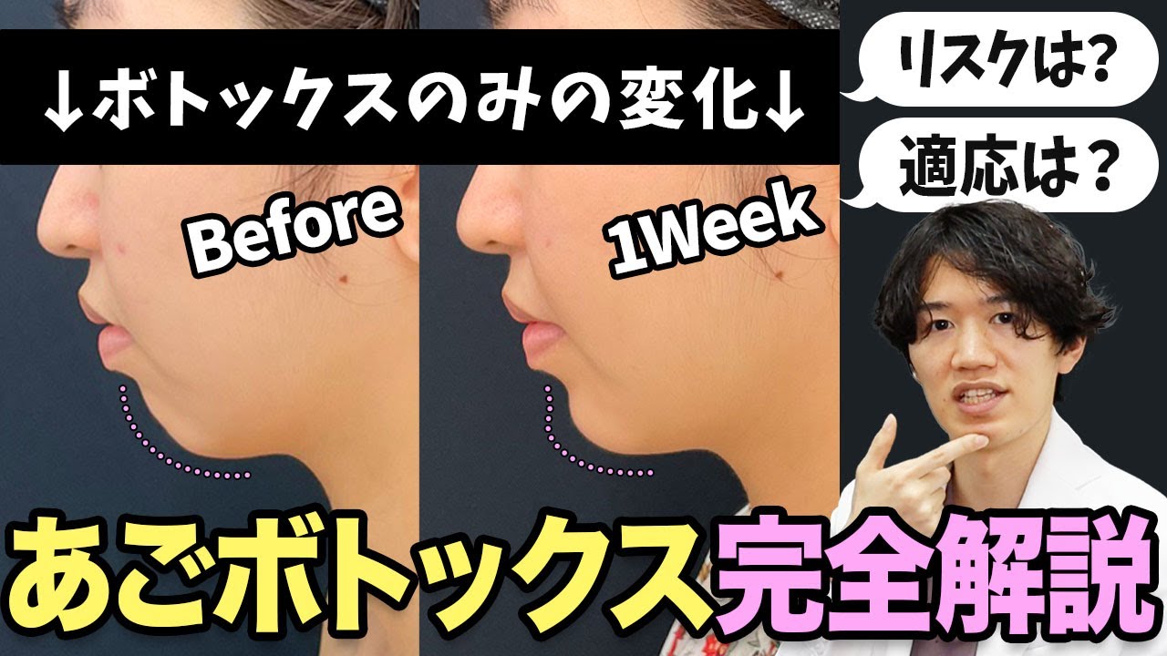 【ボトックス】顎の梅干しジワ予防だけではない、横顔美人にもなれる？！あごボトックス完全解説！【Eライン形成】