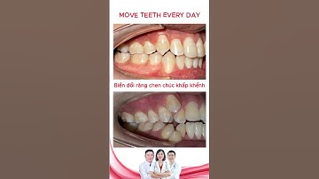 Biến đổi hàm răng chen chúc khấp khểnh | Bác sĩ Thu Gia Lâm