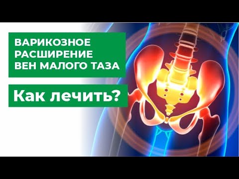 Видео: Как облегчить хроническую тазовую боль (с иллюстрациями)