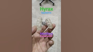 Hyrax appliance use for maxillary expansion #hyrax #dentalartbyhaider #orthodontic #dentures