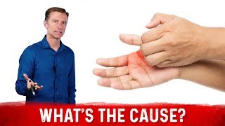 What Causes Sweaty / Dry Hands & How To Get Rid Of It? – Dr. Berg Resimi