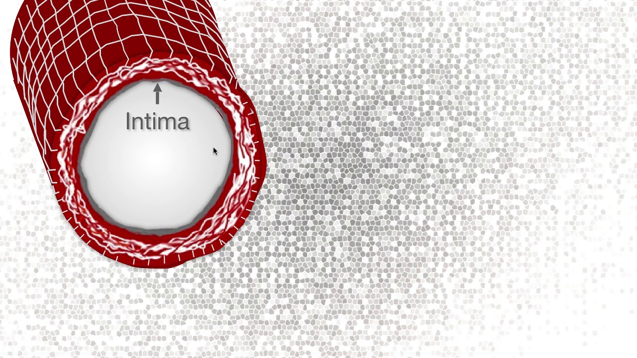 Acute Aortic Syndromes
