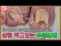 (ENG SUB)무좀 때문에 발톱이 살을 찍고있다! 너무 아파 참을수없는 무좀 때문에 생긴 내성발톱! tinea unguium / athlete's foot - Fresh Foot