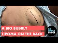 A Big Bubbly Lipoma on the Back
