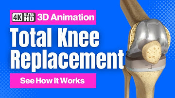 Total Knee Replacement - See How It Works