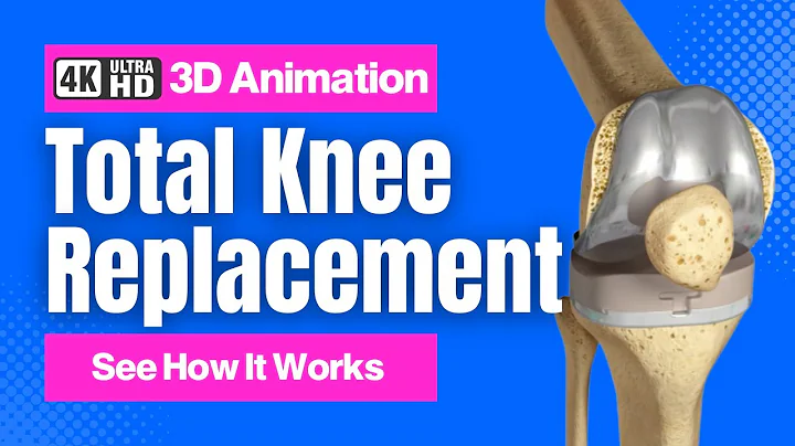 Total Knee Replacement - See How It Works