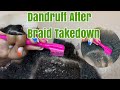 I’m Back | Braid Takedown Dandruff Scratching Part 1