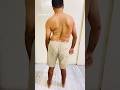 Scoliosis Treatment Scoliosistreatment Scoliosisawareness Spine Chiropractic Physio Kyphosis 