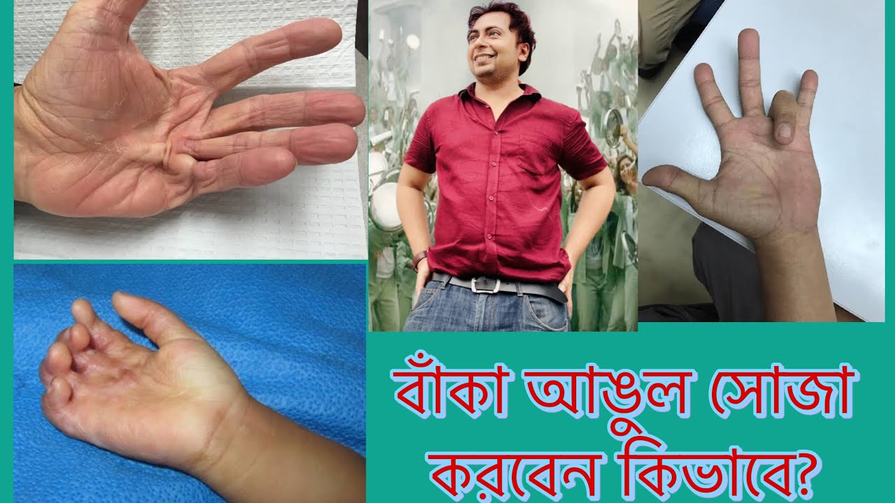 Flat Hand Problem বাঁকা আঙুল সোজা করবেন কিভাবে? Hand Contracture. Hand Deformity! - YouTube