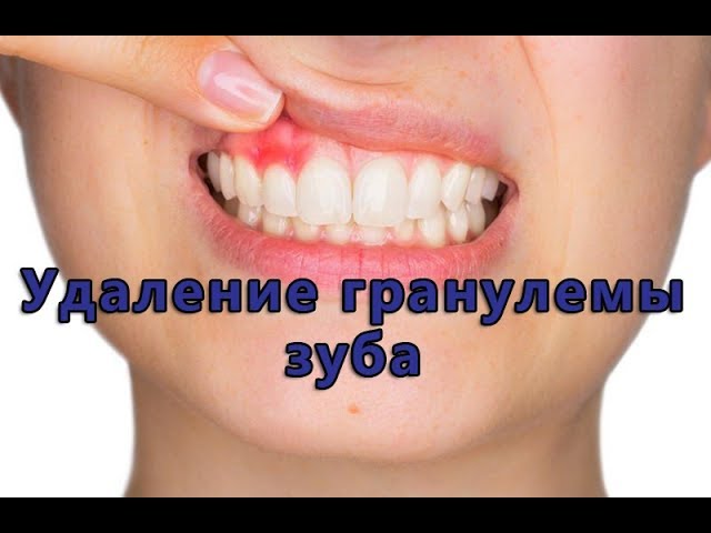Удаление или лечение гранулемы зуба
