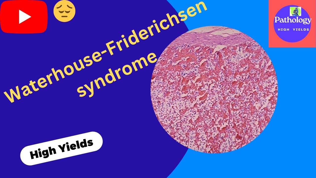 Waterhouse Friderichsen Syndrome(#Shorts)|Adrenal Insufficiency|Review-usmle,neetpg,plab,fmge