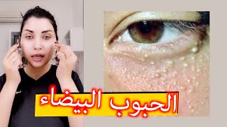 علاج الحبوب البيضاء اللي تطلع حول العين | سناب ميثاءعبدالجليل