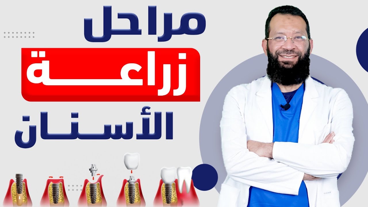 مراحل زراعة الاسنان | د. حمدي العوضي