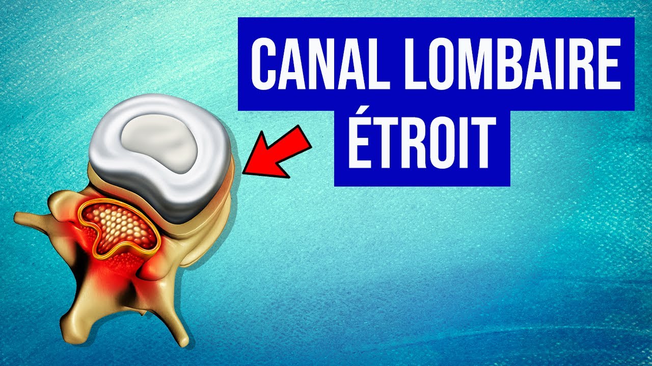 Canal lombaire étroit : Les traitements