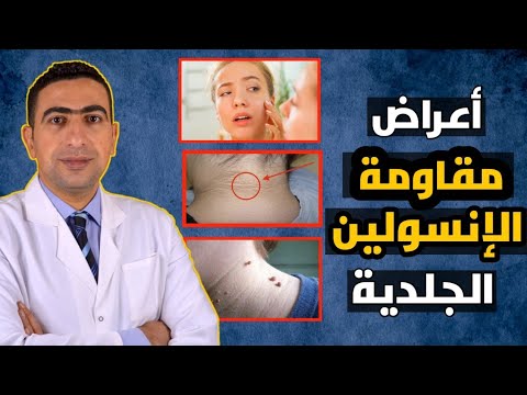 اعراض مقاومة الانسولين الجلدية علامات تظهر علي الجلد تدل علي مقاومة الانسولين