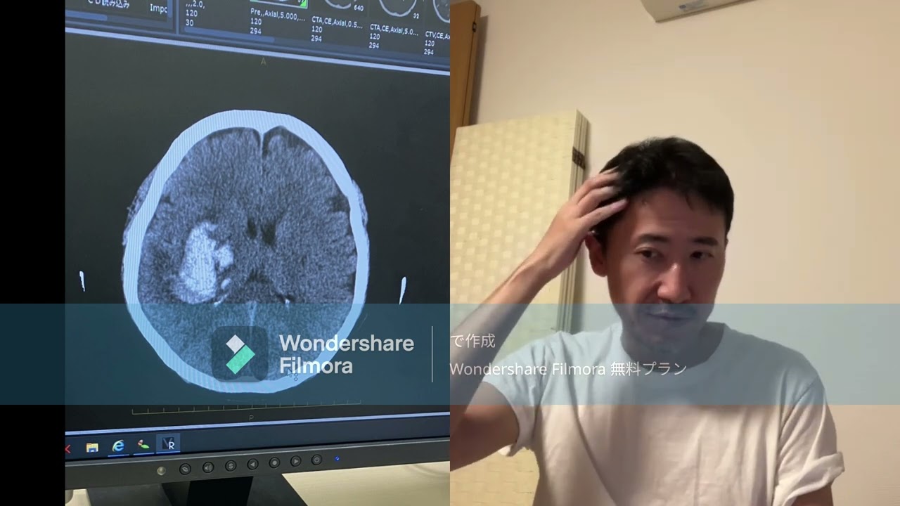 脳出血　重症でした