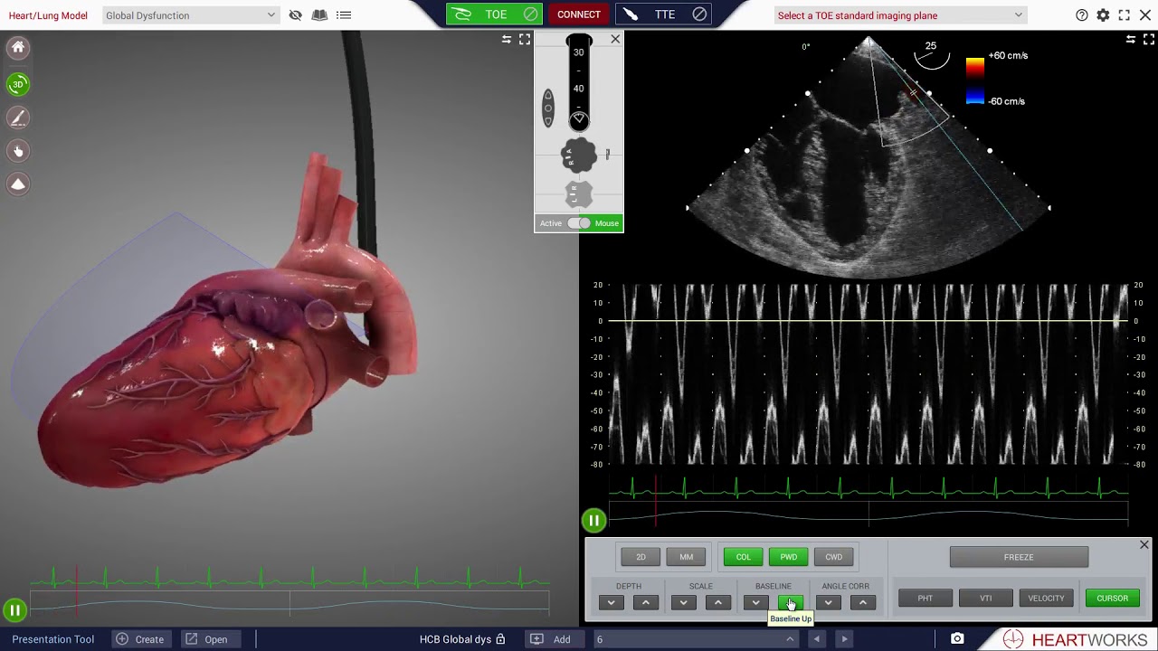 HeartWorks Global Left Ventricular Dysfunction 