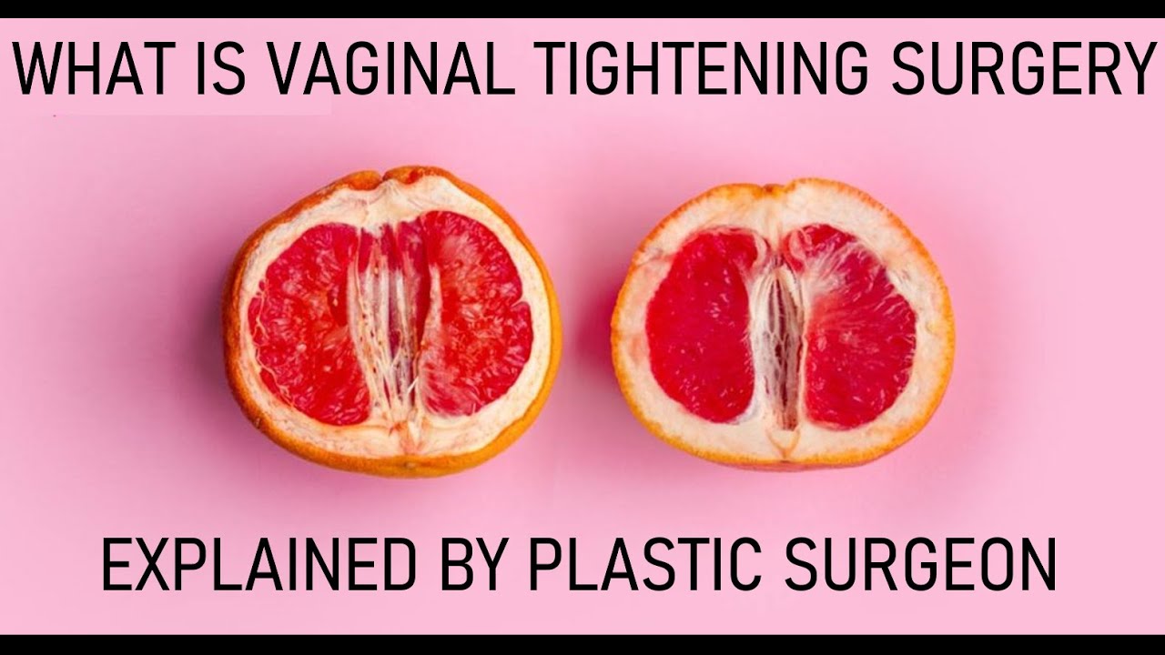 What Is Vaginal Tightening Surgery Explained By Plastic Surgeon Youtube