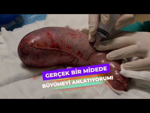 Gerçek Bir Midede Büyümeyi Anlatıyorum!