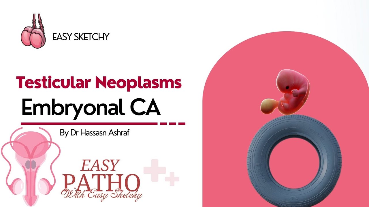 embryonal-carcinoma-pathology-visual-mnemonics-male-genital-system