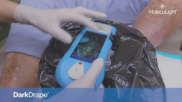 Using the MolecuLight DarkDrape for Imaging of Wounds